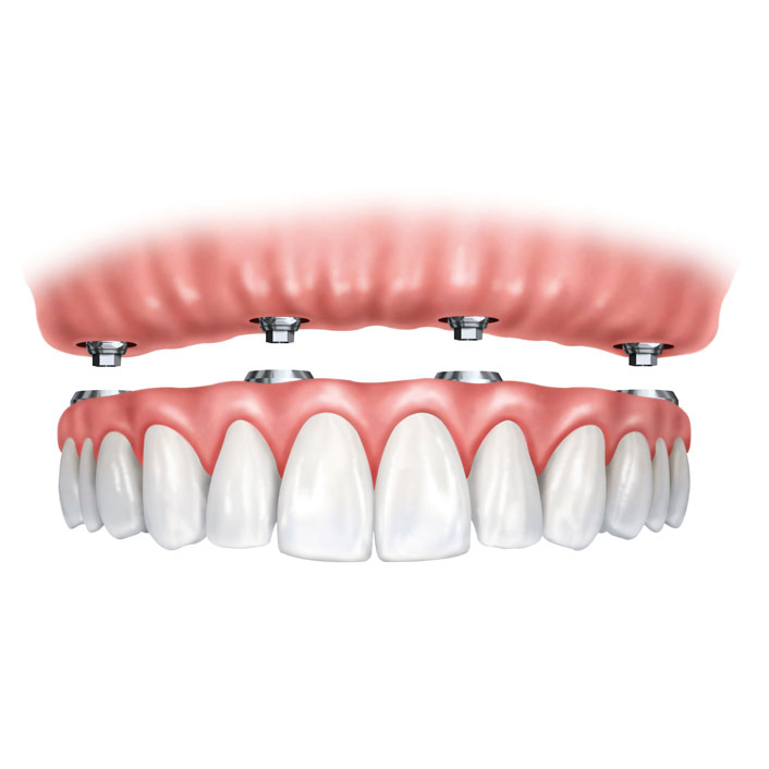 Dental Implant Supported Dentures